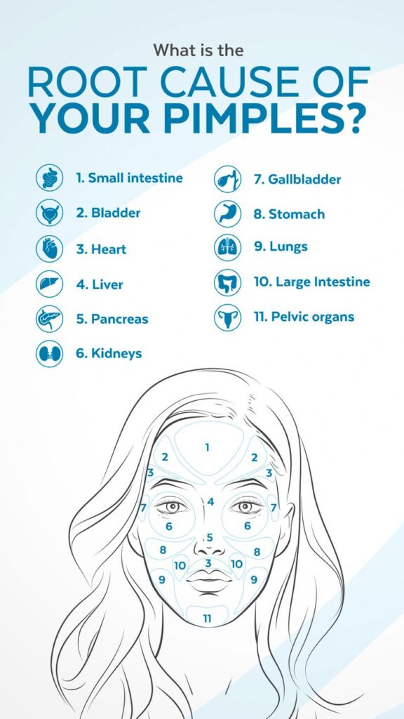 pimples on cheeks chin & forehead