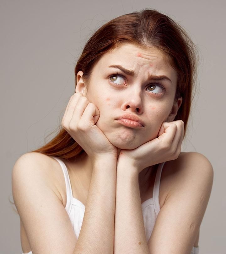 pimples on cheeks chin & forehead