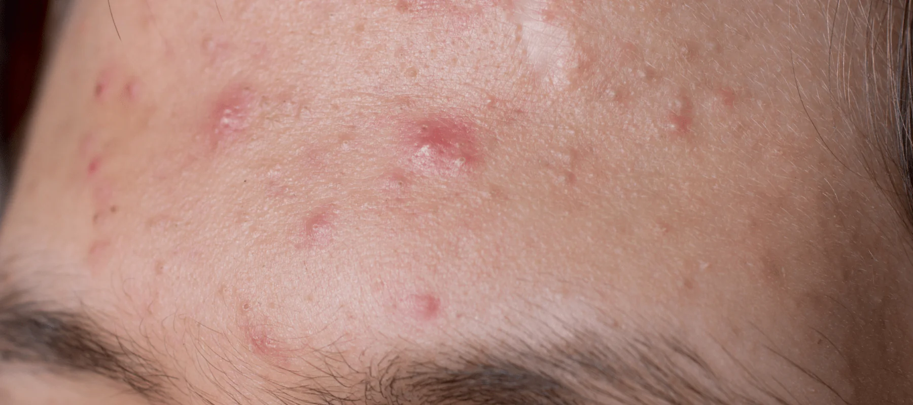 best face wash for acne under 500